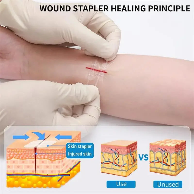 Zipper Band-Aid Wound Tie Emergency Wound Closure Device Repair Wounds Without Stitches Quick Painless Band Aid Health Care