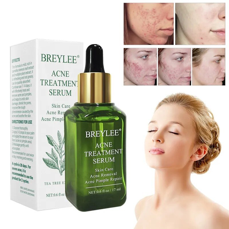 BREYLEE Acne Treatment Serum Facial Anti Acne Scar Removal Cream Whitening Repair Pimple Remover Skin Care TSLM2 - Jaazi Intl